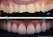 Keramicke fasete 2 - Centar za dentalnu estetiku i implantologiju