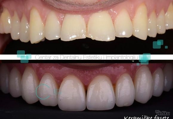 Keramicke fasete 2 - Centar za dentalnu estetiku i implantologiju