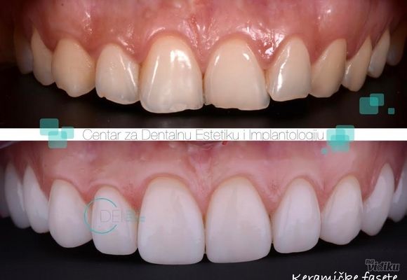 Keramicke fasete 3 - Centar za dentalnu estetiku i implantologiju