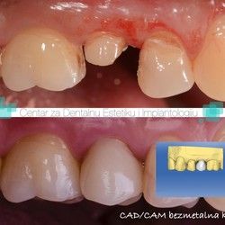 Cad Cam 1 - Centar za dentalnu estetiku i implantologiju