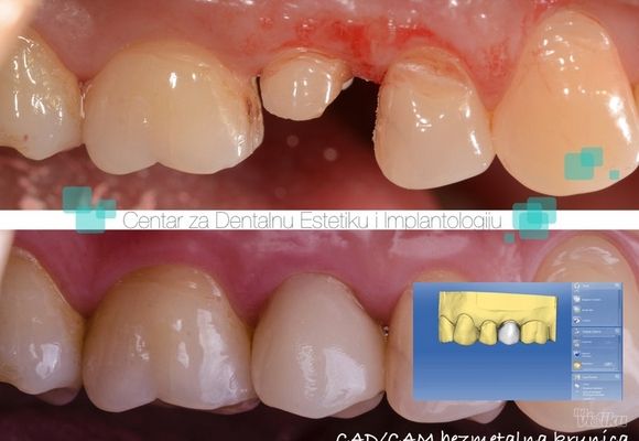 Cad Cam 1 - Centar za dentalnu estetiku i implantologiju