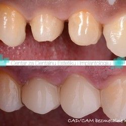Cad Cam 2 - Centar za dentalnu estetiku i implantologiju