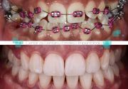 Ortodoncija 1 - Centar za dentalnu estetiku i implantologiju