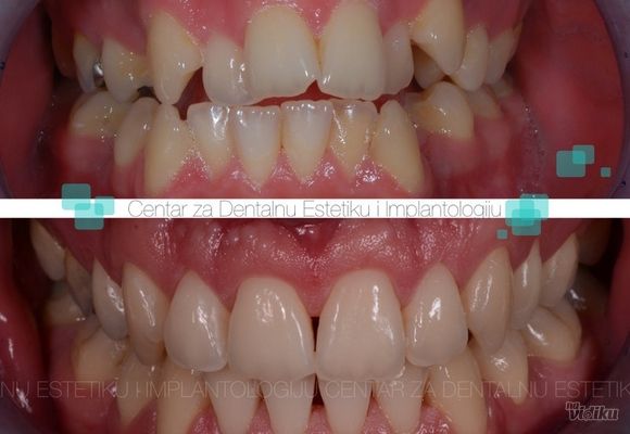 Ortodoncija 2 - Centar za dentalnu estetiku i implantologiju