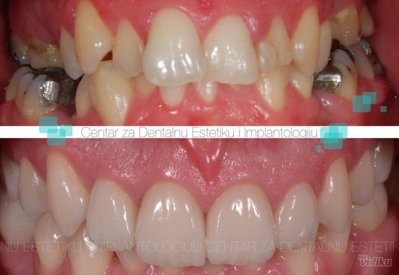 Ortodoncija 3 - Centar za dentalnu estetiku i implantologiju