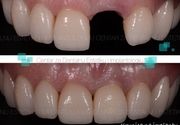 Zubni implanti 2 - Centar za dentalnu estetiku i implantologiju