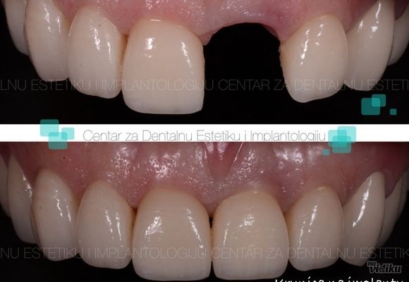 Zubni implanti 2 - Centar za dentalnu estetiku i implantologiju