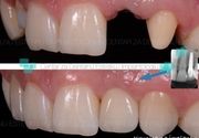 Zubni implanti 3 - Centar za dentalnu estetiku i implantologiju