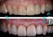 Zubni implanti 4 - Centar za dentalnu estetiku i implantologiju