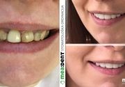 Zubni implanti Klijent 34