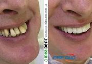 Zubni implanti Klijent 39
