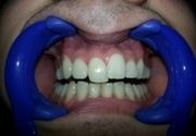Zubni implanti Klijent 41