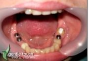 Zubni implanti Klijent 42