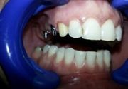 Zubni implanti Klijent 43