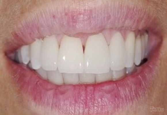 Zubni implanti Klijent 44