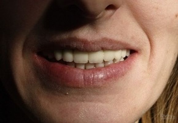 Zubni implanti Klijent 45