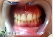 Zubni implanti Klijent 46