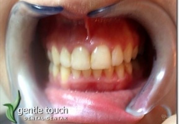 Zubni implanti Klijent 46