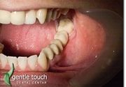 Zubni implanti Klijent 47