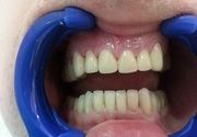 Zubni implanti Klijent 48