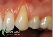 Zubni implanti Klijent 49