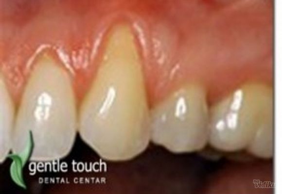 Zubni implanti Klijent 49