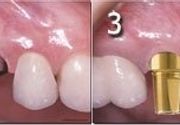 Zubni implanti Klijent 50