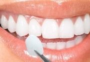 Izbeljivanje zuba Klijent 2