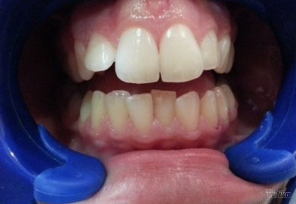 Izbeljivanje zuba Klijent 4