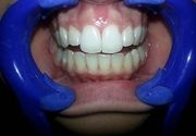 Izbeljivanje zuba Klijent 4