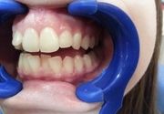 Izbeljivanje zuba Klijent 5