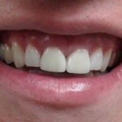 Izbeljivanje zuba Klijent 22