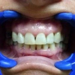 Izbeljivanje zuba Klijent 24