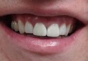 Izbeljivanje zuba Klijent 26