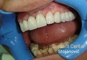 Izbeljivanje zuba Klijent 27