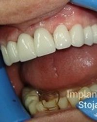 Izbeljivanje zuba Klijent 27