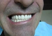 Izbeljivanje zuba Klijent 28