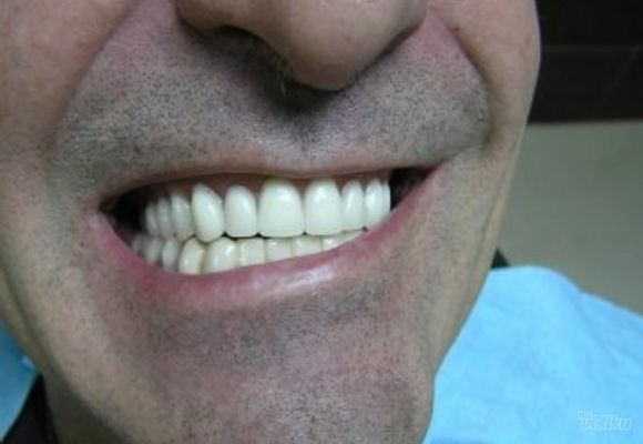 izbeljivanje-zuba-klijent-28---stomatoloska-ordinacija-dental-petrovic.jpg