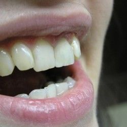 Izbeljivanje zuba Klijent 29