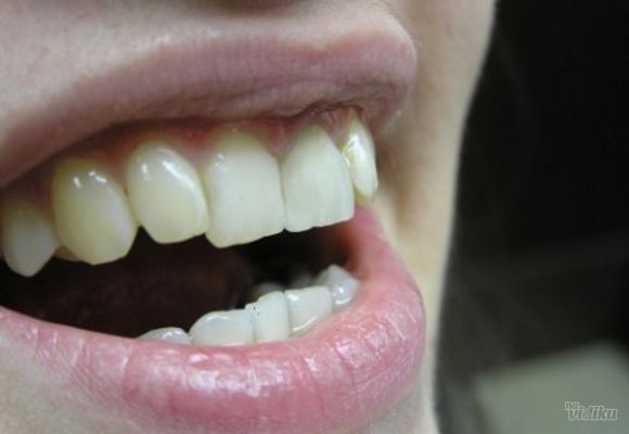izbeljivanje-zuba-klijent-29---stomatoloska-ordinacija-dental-petrovic.jpg