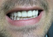 Izbeljivanje zuba Klijent 30