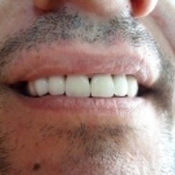 Izbeljivanje zuba Klijent 31