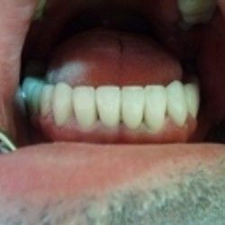 Izbeljivanje zuba Klijent 32
