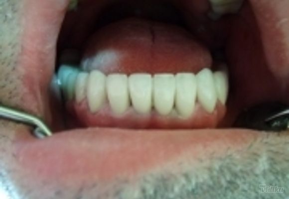 Izbeljivanje zuba Klijent 32