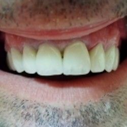 Izbeljivanje zuba Klijent 33