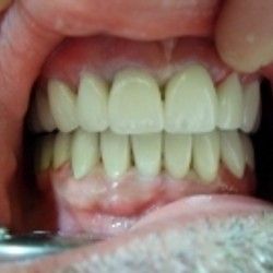 Izbeljivanje zuba Klijent 34