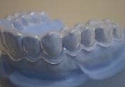 Izbeljivanje zuba Klijent 36
