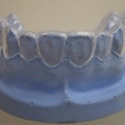 Izbeljivanje zuba Klijent 40