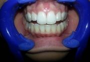 Izbeljivanje zuba Klijent 50