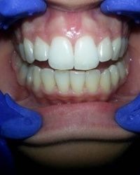 Izbeljivanje zuba Klijent 50